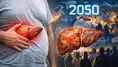 Metabolik karaciğer hastalığında alarm: 2050’ye kadar 1,8 milyar kişi etkilenebilir