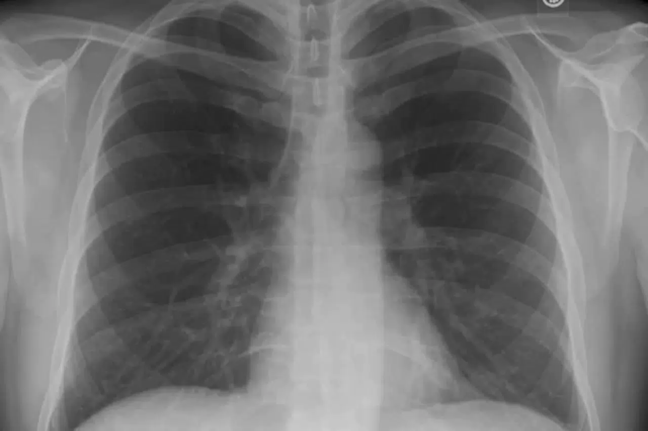 Silikozis Hastası İşçiler: "Ölmeden Davamız Sonuçlansın"