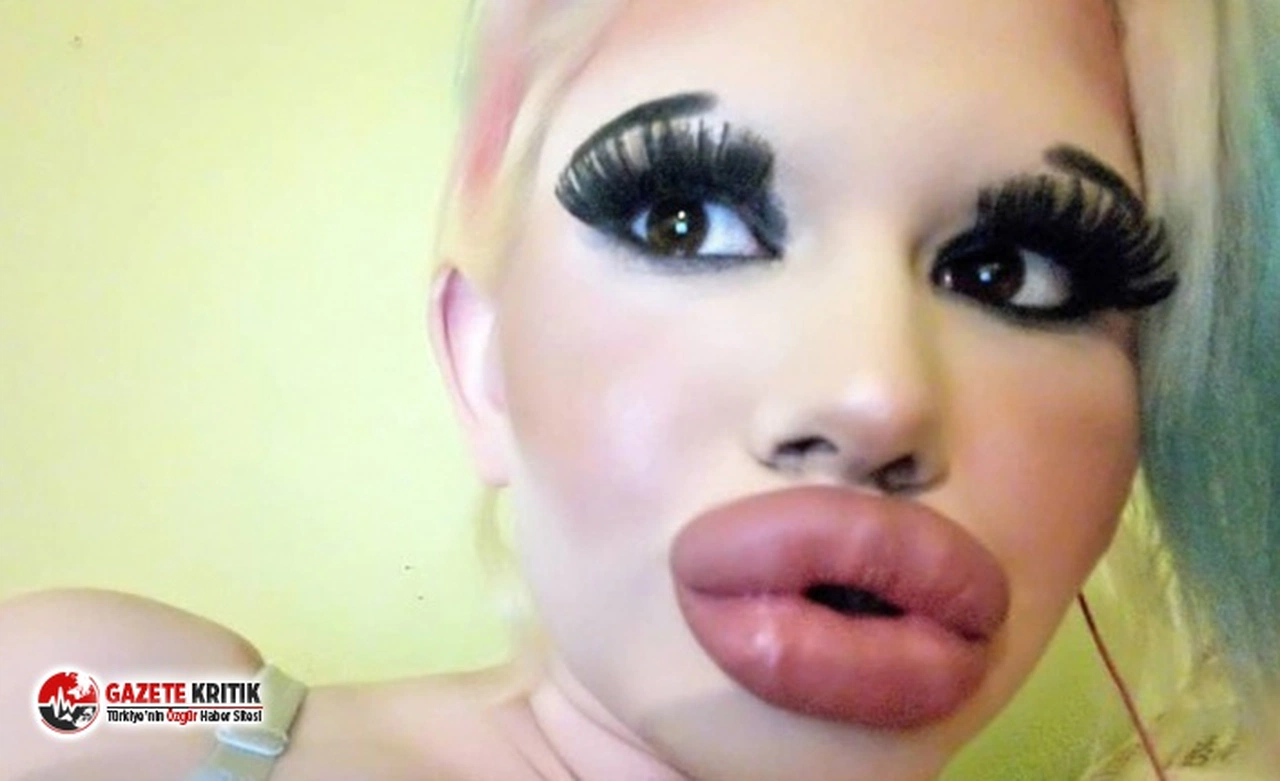 Dünyanın en büyük dudaklarına sahip olmak için 15 operasyon geçirdi