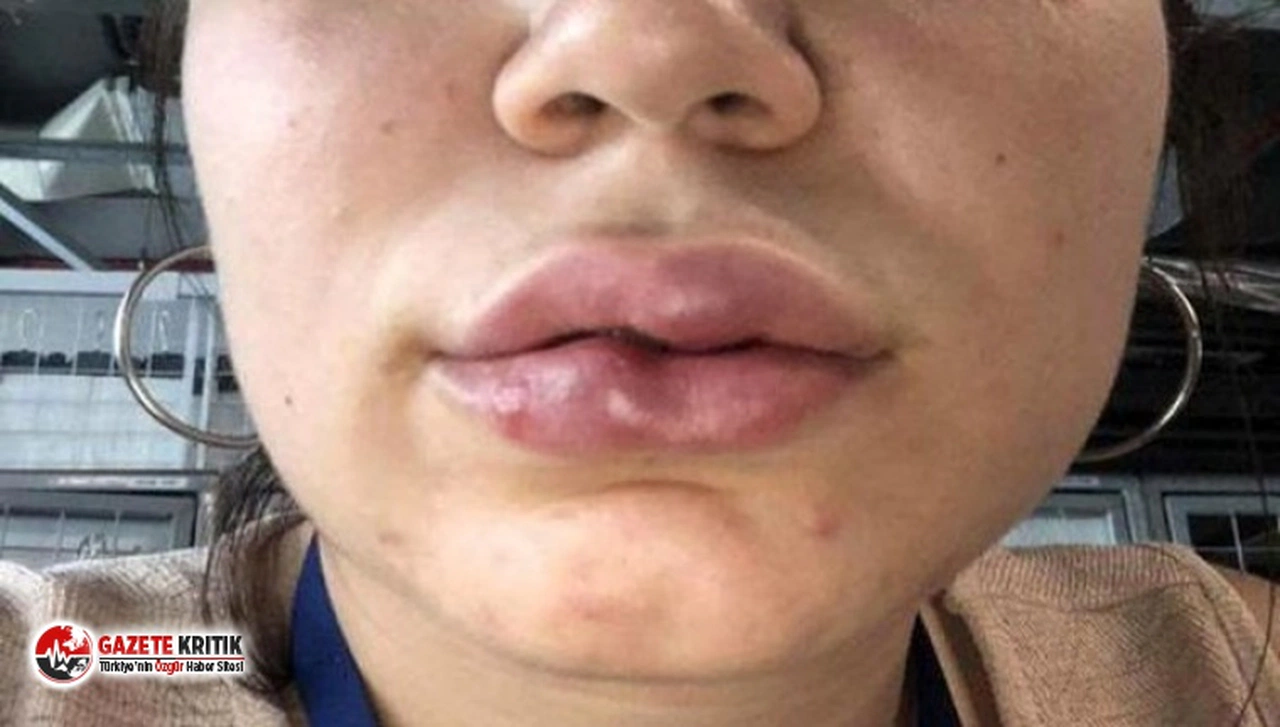 Dudak dolgusunda ''doktor ihmali” iddiasıyla 250 bin liralık dava açtı