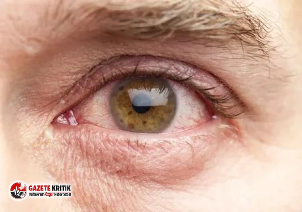 Koronavirüs gözden de bulaşabiliyor