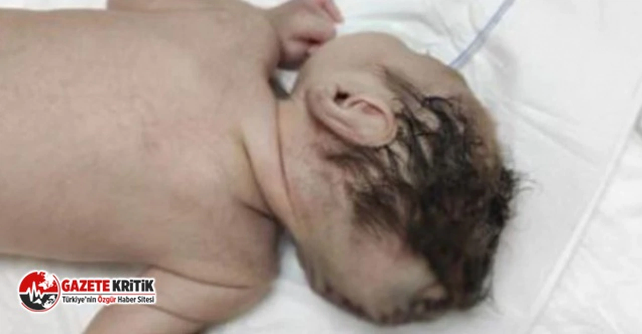 Beyninin yarısı kafatası dışında dünyaya geldi