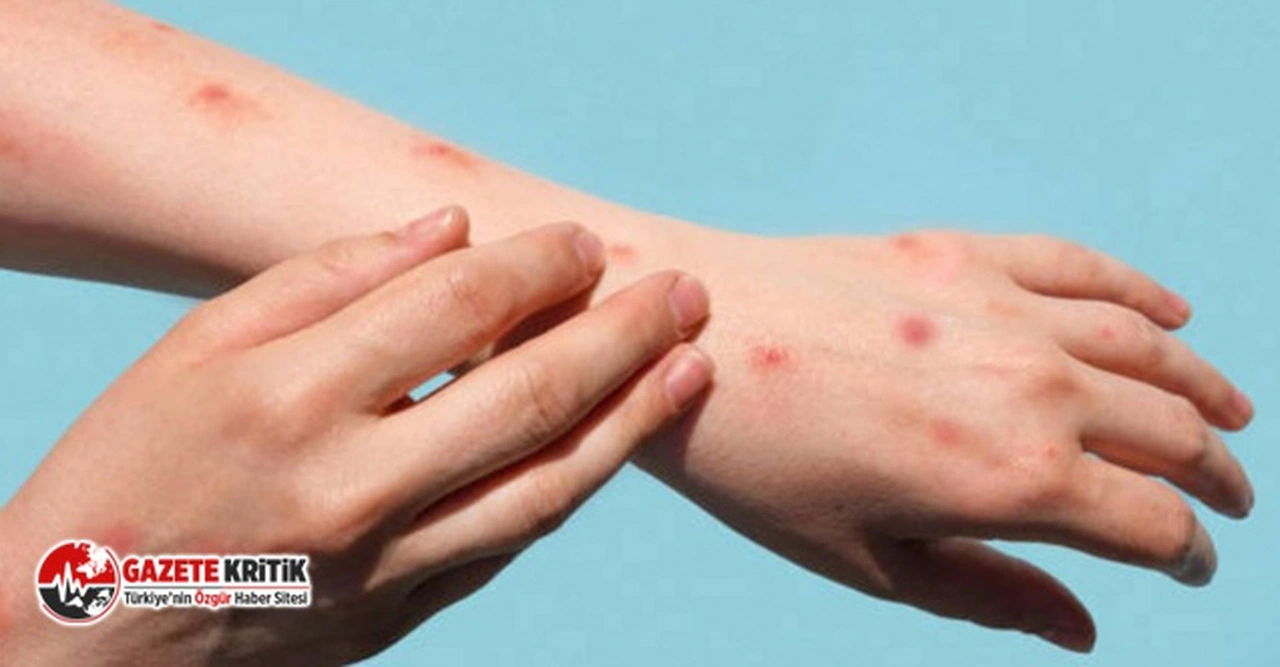 Sağlık Bakanlığı'ndan “kızamık” alarmı: 81 ile yazı gönderildi