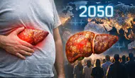 Metabolik karaciğer hastalığında alarm: 2050’ye kadar 1,8 milyar kişi etkilenebilir