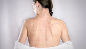 ABD’de kızamık salgını büyüyor: Vaka sayıları artıyor, hastaneye yatışlar dikkat çekiyor