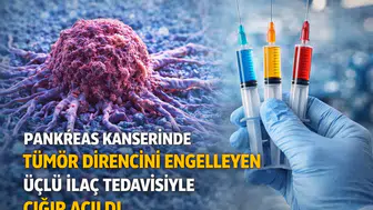 Pankreas Kanserinde Tümör Direncini Engelleyen Üçlü İlaç Tedavisiyle Çığır Açıldı