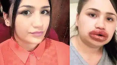 Türkiye onu dudaklarıyla tanımıştı! İşte son hali