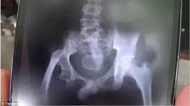Doktorlar şaştı kaldı: 14 yaşındaki çocuk gözlerinin önünde 'yumurtladı'
