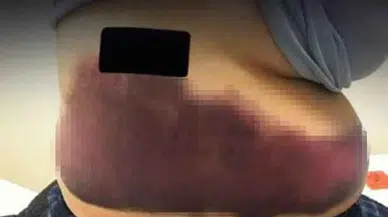 Grip olduktan sonra vücudu morarmaya başladı. 2. kez doktora gittiğinde korkunç gerçek ortaya çıktı!