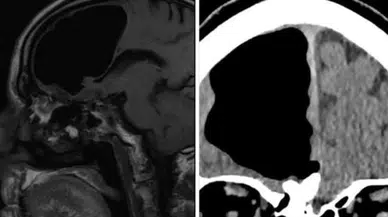 Baş ağrısıyla hastaneye gitti, röntgen sonuçları şok etti