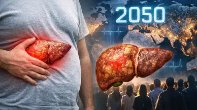 Metabolik karaciğer hastalığında alarm: 2050’ye kadar 1,8 milyar kişi etkilenebilir
