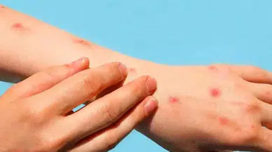 Lupus hastalığı neden olur? Bulaşıcı mıdır?