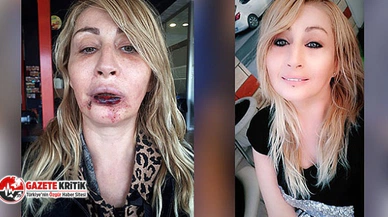 Yine bir estetik faciası: Güzellik uğruna bu hale geldi!