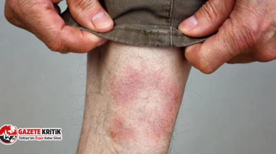 Lyme Hastalığı Nedir?