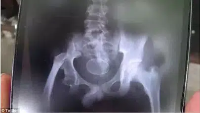 Doktorlar şaştı kaldı: 14 yaşındaki çocuk gözlerinin önünde 'yumurtladı'