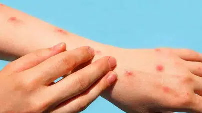 Lupus hastalığı neden olur? Bulaşıcı mıdır?