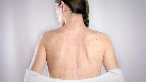 ABD’de kızamık salgını büyüyor: Vaka sayıları artıyor, hastaneye yatışlar dikkat çekiyor