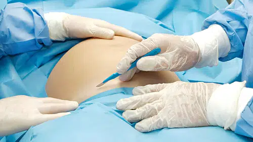 TBMM'de Sezaryen Tartışması: Kadın Vekillerin Tepkisi Gündem Oldu